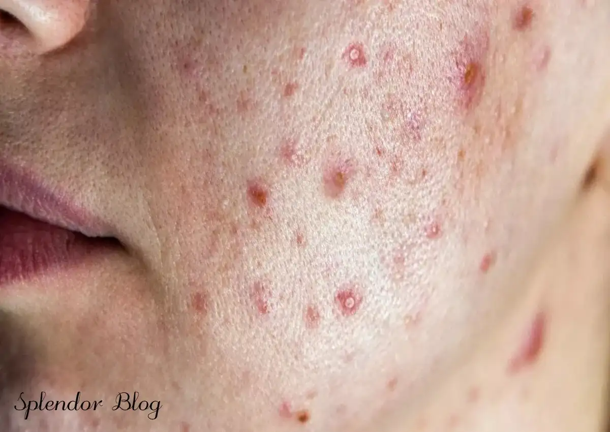 accutane endicia